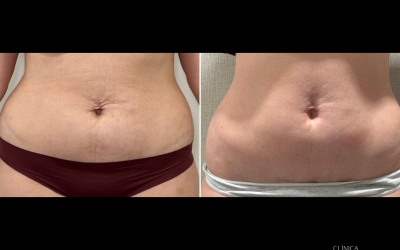 Endoláser Corporal: La Alternativa a la Liposucción que querrás conocer · Medicina Estética en Chamberí, Madrid