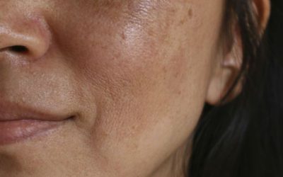 Melasma: Qué es, causas y tratamiento eficaz en Madrid | Clínica López Azpúrua